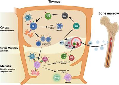 Autoimmunity in thymic epithelial tumors: a not yet clarified pathologic paradigm associated with several unmet clinical needs